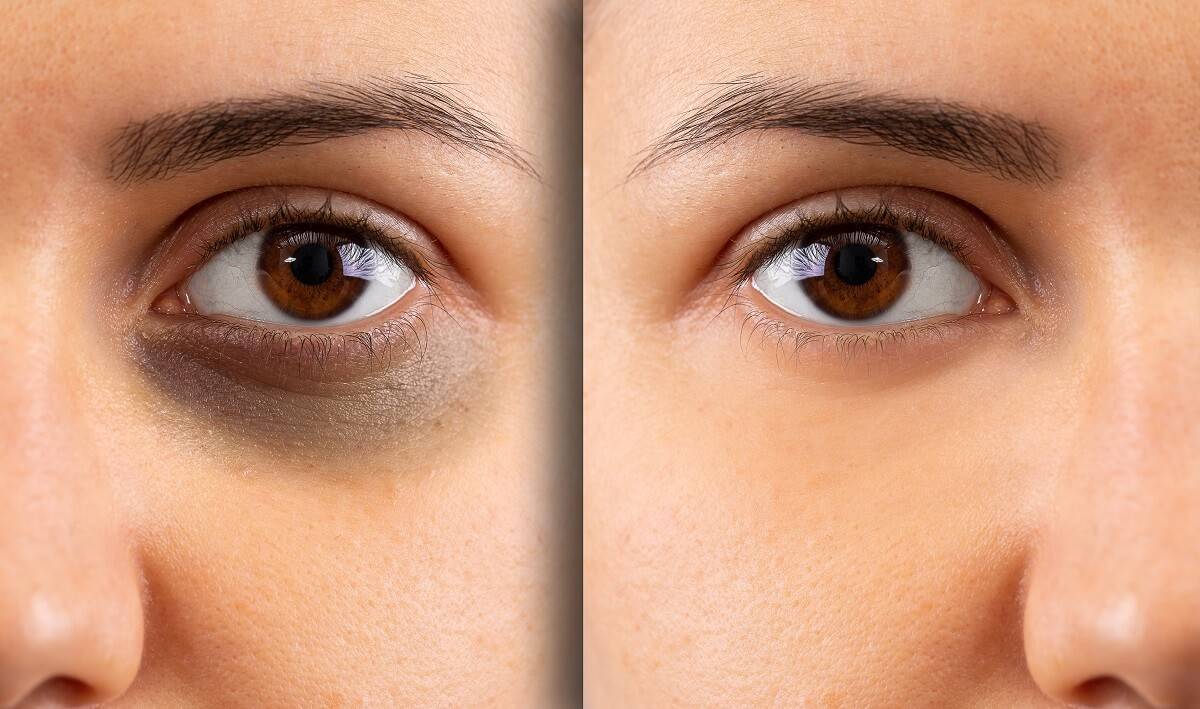 Why Do Under-Eye Dark Circles Occur? What are the treatment methods?