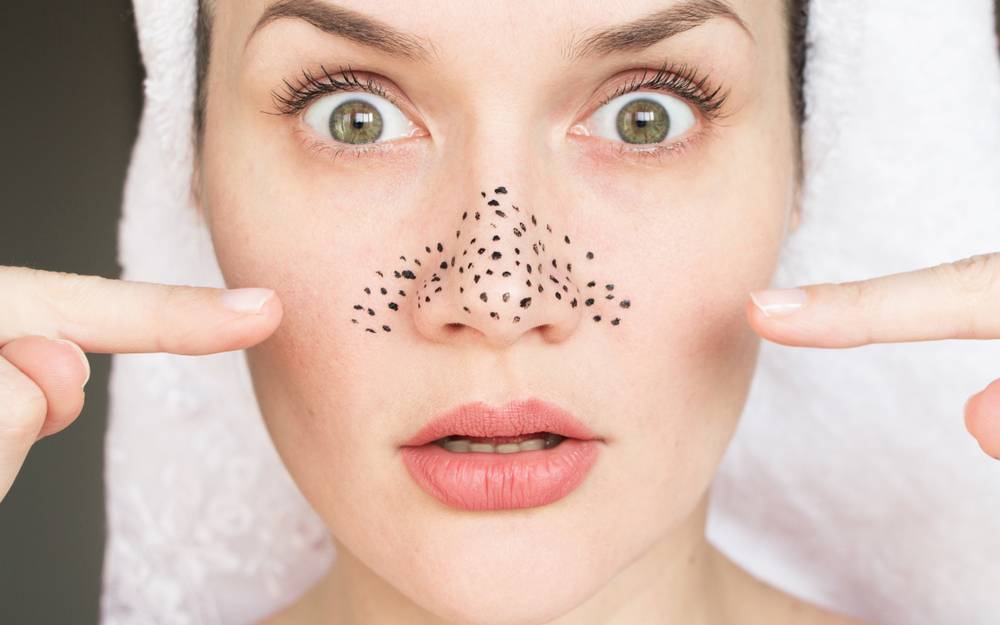 What is Blackhead? How is it formed?