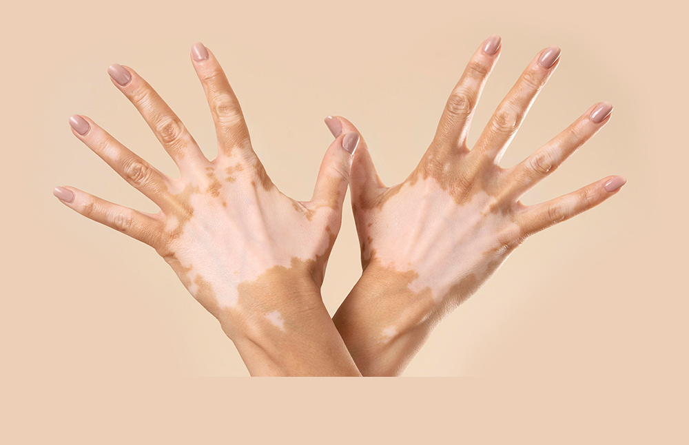 Vitiligo Nedir?